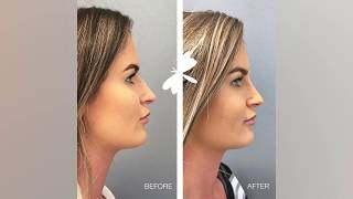 Non Surgical Nose Reshaping  The Laser and Skin Clinic [upl. by Mmada]