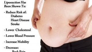 Liposuction Benefits and Risks [upl. by Gautier]