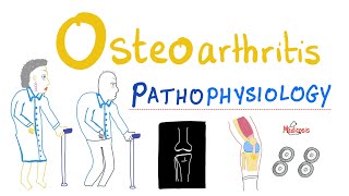 Osteoarthritis OA  Pathophysiology  Rheumatology Series [upl. by Araem63]