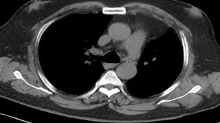 Picture Tests in Anatomy  Thorax  Wall and Lung 2 [upl. by Philis]