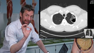 Hiatal Hernia Chest Xray [upl. by Assennev804]