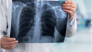 Chest Xray Introduction and Approach [upl. by Noirad]