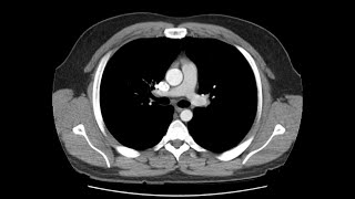 1Anatomie du thorax en 3D [upl. by Atinek]