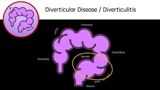 Diverticular Disease and Diverticulitis [upl. by Riehl673]