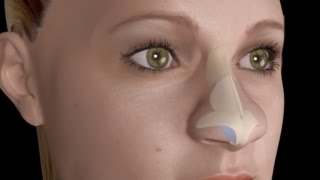 Bulbous Large Nasal Tip Nose Job Rhinoplasty [upl. by Allerbag]