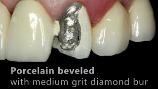 Porcelain Fused to Metal PFM Repair  Cosmedent Inc [upl. by Aillimat]