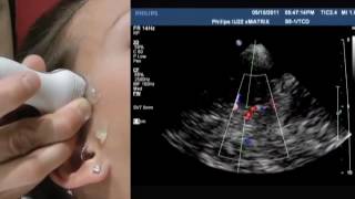 How To Transcranial Doppler [upl. by Land]