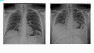 Introduction to Computed Tomographic imaging of the Chest [upl. by Latt883]