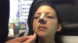 How to clean your nose after rhinoplasty [upl. by Berkie]