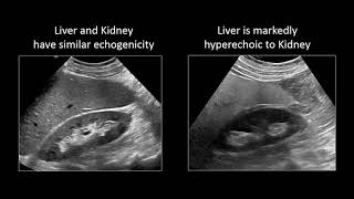 GI Imaging  Hepatic Steatosis and Cirrhosis [upl. by Ress]