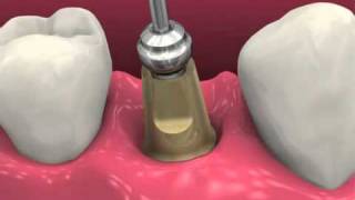 Restoring BioHorizons Dental Implants 2011 [upl. by Attenra521]