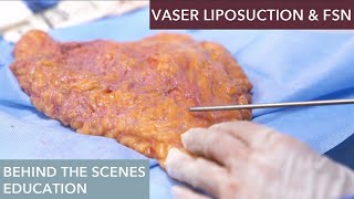 The Science Behind Vaser Liposuction How Does It Work [upl. by Atteuqal]