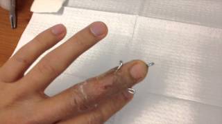 Broken finger pin removal [upl. by Nnylrac]