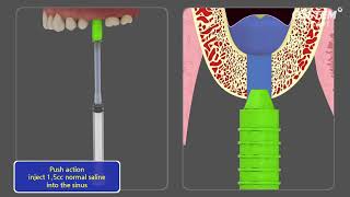 CAS KIT Crestal Approach  Sinus KIT [upl. by Nyrhtac986]