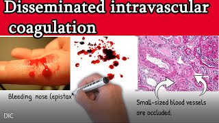 Disseminated intravascular coagulation DIC  Causes Symptoms Treatment and prognosis [upl. by Gardol]