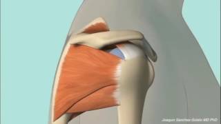 Chronic Subacromial Impingement Animation [upl. by Nagel]