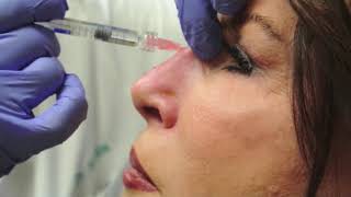 Nonsurgical Rhinoplasty [upl. by Ellerd]