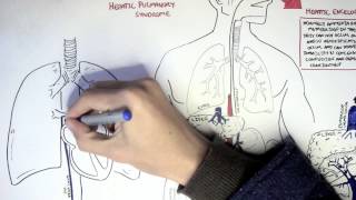 Liver Cirrhosis [upl. by Yrad]