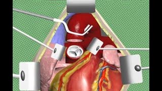 Aortic Valve Replacement Surgery Animation by Cal Shipley MD [upl. by Eidna]