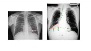 Anatomy Thorax Overview  Ribs Sternal angle Pleura and Pneumothorax [upl. by Nossah]