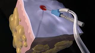 How Liposuction Works Animation  Liposuction Procedure Video [upl. by Ydarg]