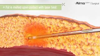 Laser Liposuction [upl. by Aiak]