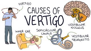 Understanding the Causes of Vertigo [upl. by Adalheid]