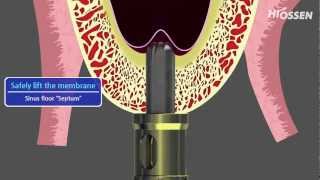 OSSTEM  HIOSSEN CASKit Crestal Approach Sinus Kit [upl. by Nillok221]