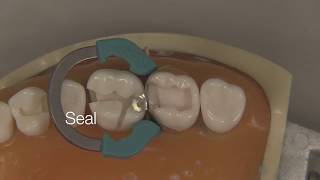 Class II Composite Restoration  Stevenson Dental Solutions [upl. by Kelsy]