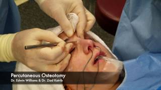 Percutaneous Osteotomy amp Breaking the Nose During Rhinoplasty Surgery [upl. by Siuqcram]