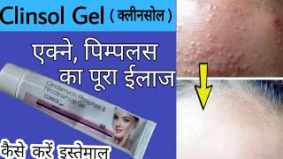 Clinsol Gel Review In Hindi  एक्ने पिम्पलस ऑयली स्किन की असरदार दवा [upl. by Cormier898]