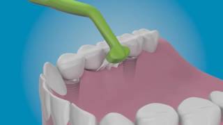 Clean the inside of your dental implants with TePe Implant Care™ [upl. by Shulman887]