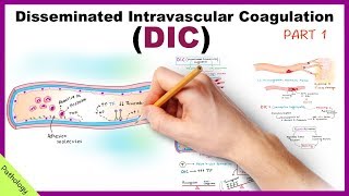 DIC Disseminated Intravascular Coagulation  Part 1 [upl. by Tuckie319]