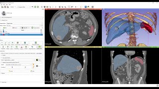 AIassisted segmentation using free tools  3D Slicer and Nvidia Clara [upl. by Revlys]