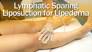 Lipedema Liposuction Surgery  Lymphatic Sparing  Expert Dr Thomas Su  ArtLipo [upl. by Yelsna]